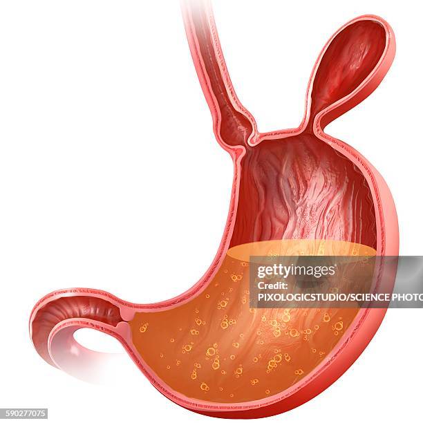 stomach with hernia, illustration - abdominal hernia stock illustrations