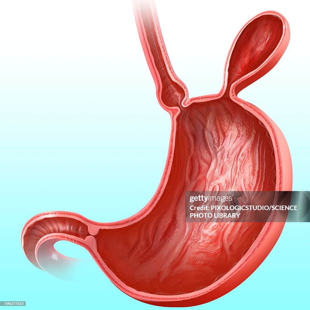 Stomach with hernia, illustration