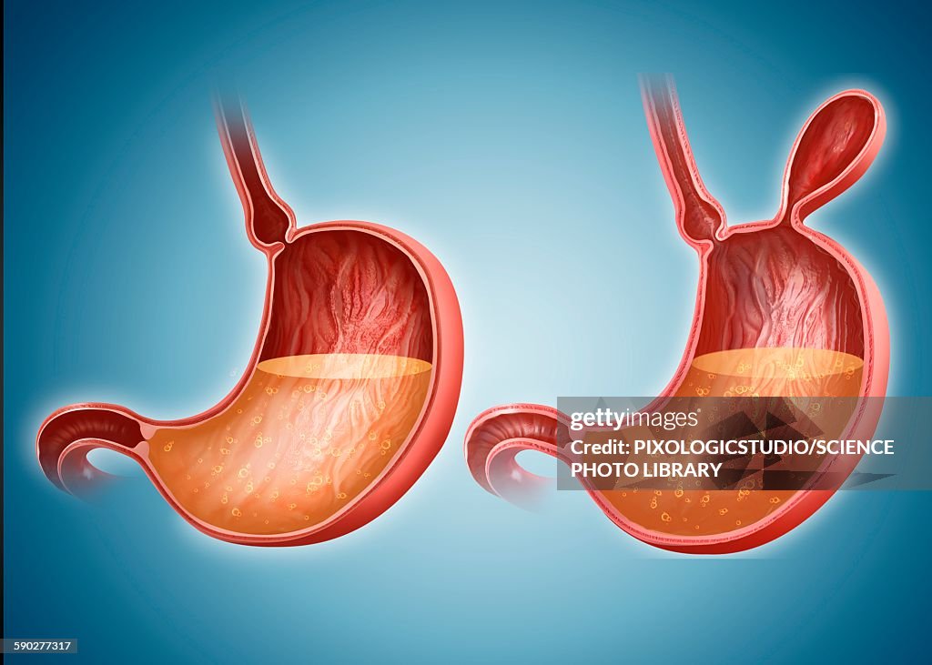 Stomach with and without hernia
