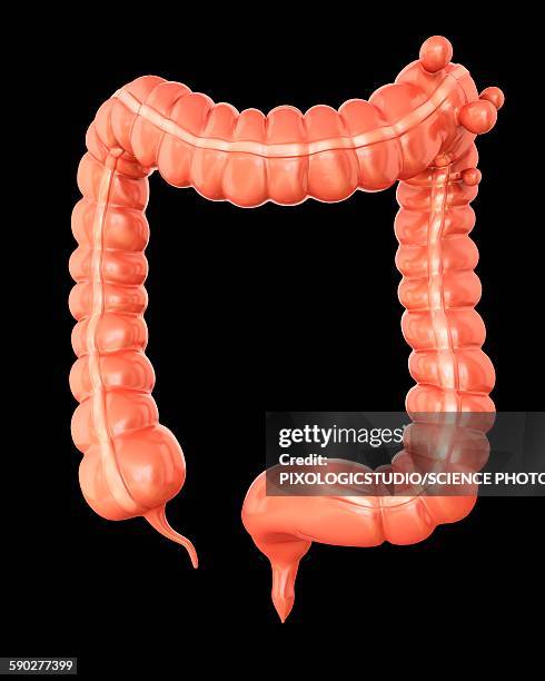 diverticulitis, illustration - diverticulitis stock illustrations