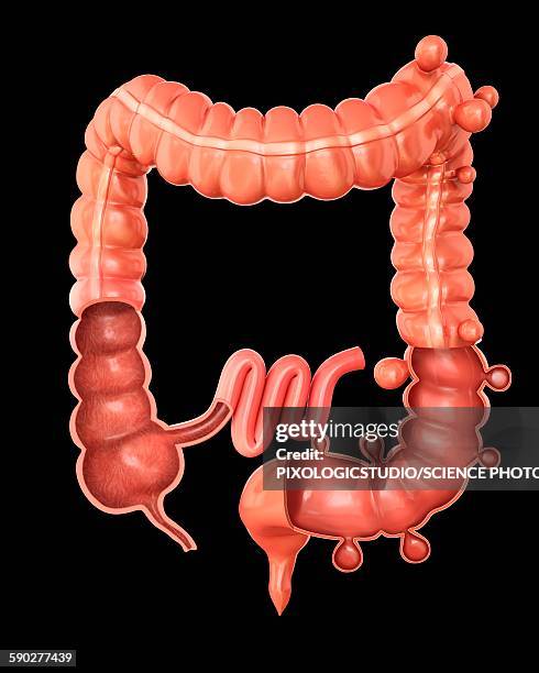 diverticulitis, illustration - diverticulitis stock illustrations