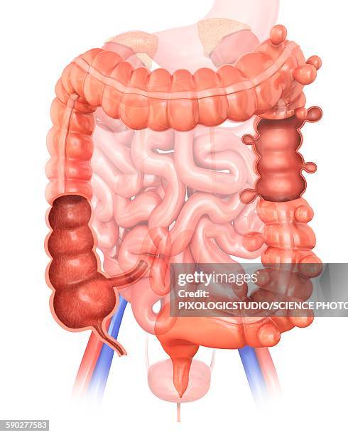 diverticulitis, illustration - diverticulitis stock illustrations