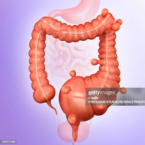 diverticulitis, illustration - diverticulitis stock-grafiken, -clipart, -cartoons und -symbole