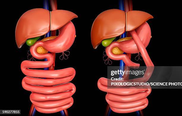 gastric bypass, illustration - gastric bypass stock illustrations