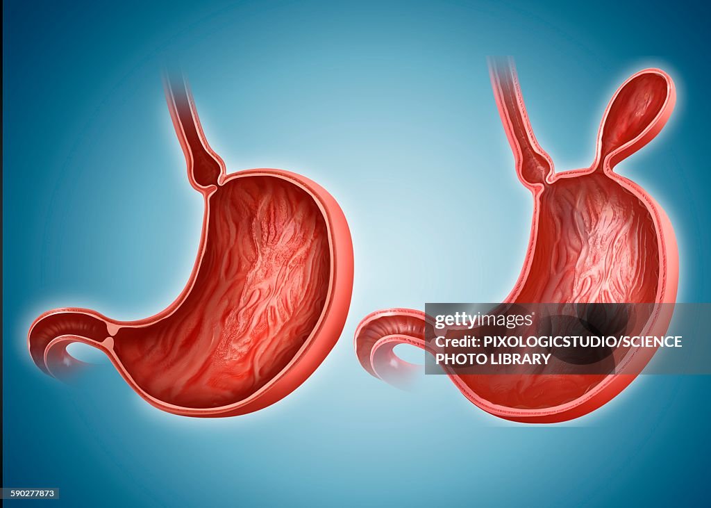 Stomach with and without hernia