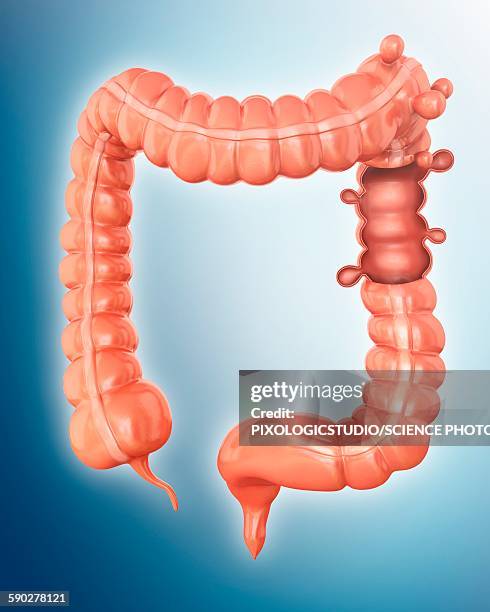 diverticulitis, illustration - diverticulitis stock-grafiken, -clipart, -cartoons und -symbole