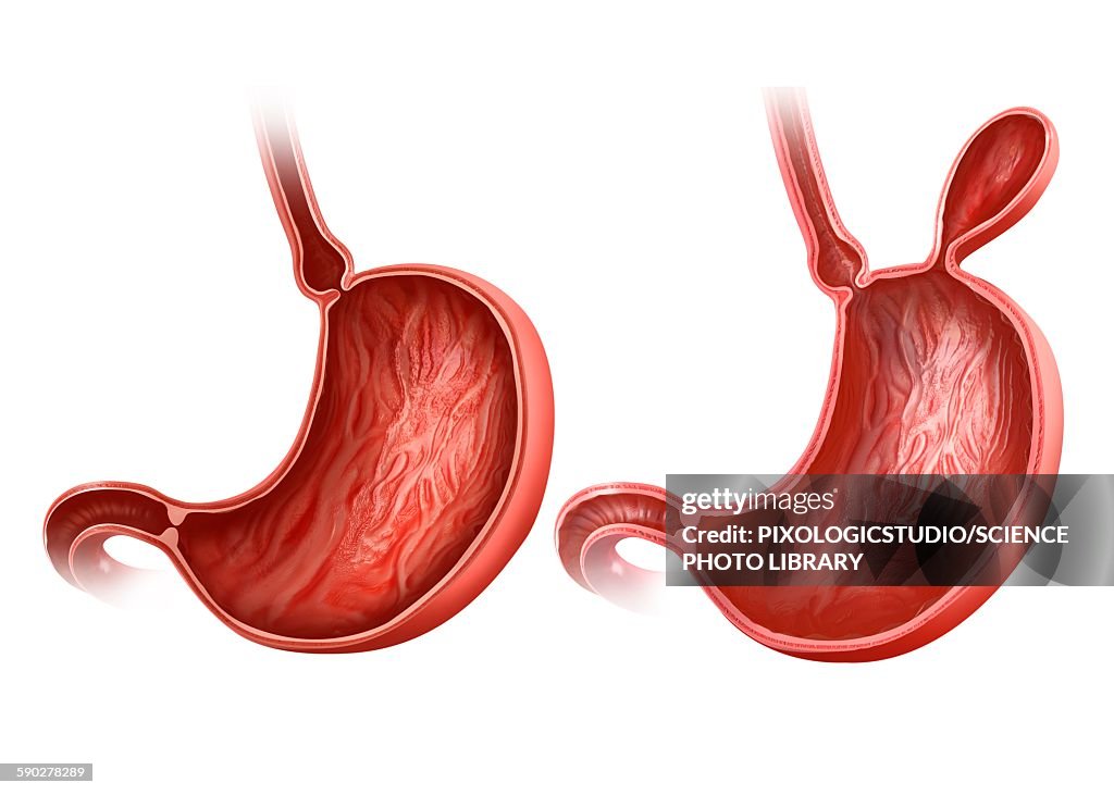 Stomach with and without hernia