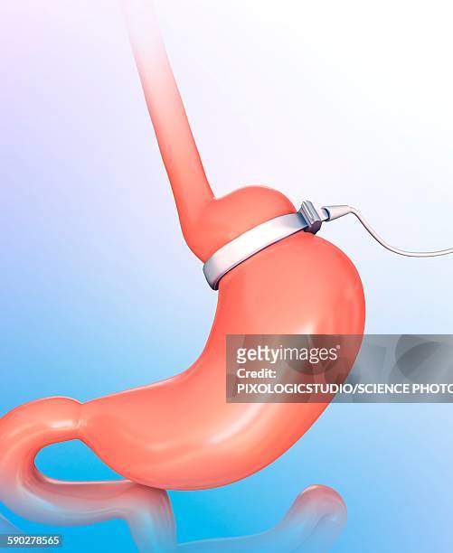 human gastric band, illustration - gastric band treatment stock illustrations