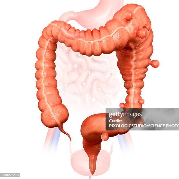 megacolon and diverticulitis - diverticulitis stock-grafiken, -clipart, -cartoons und -symbole