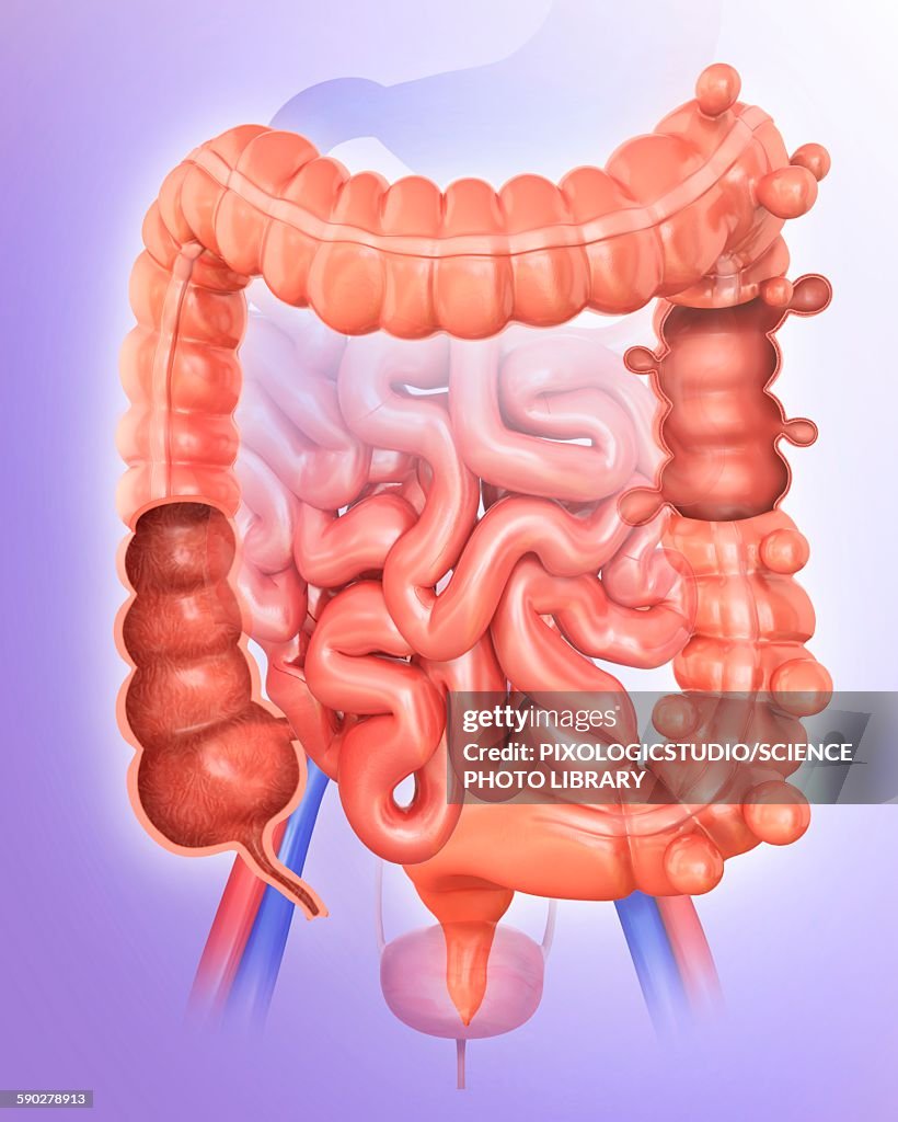 Diverticulitis Illustration StockIllustration Getty Images