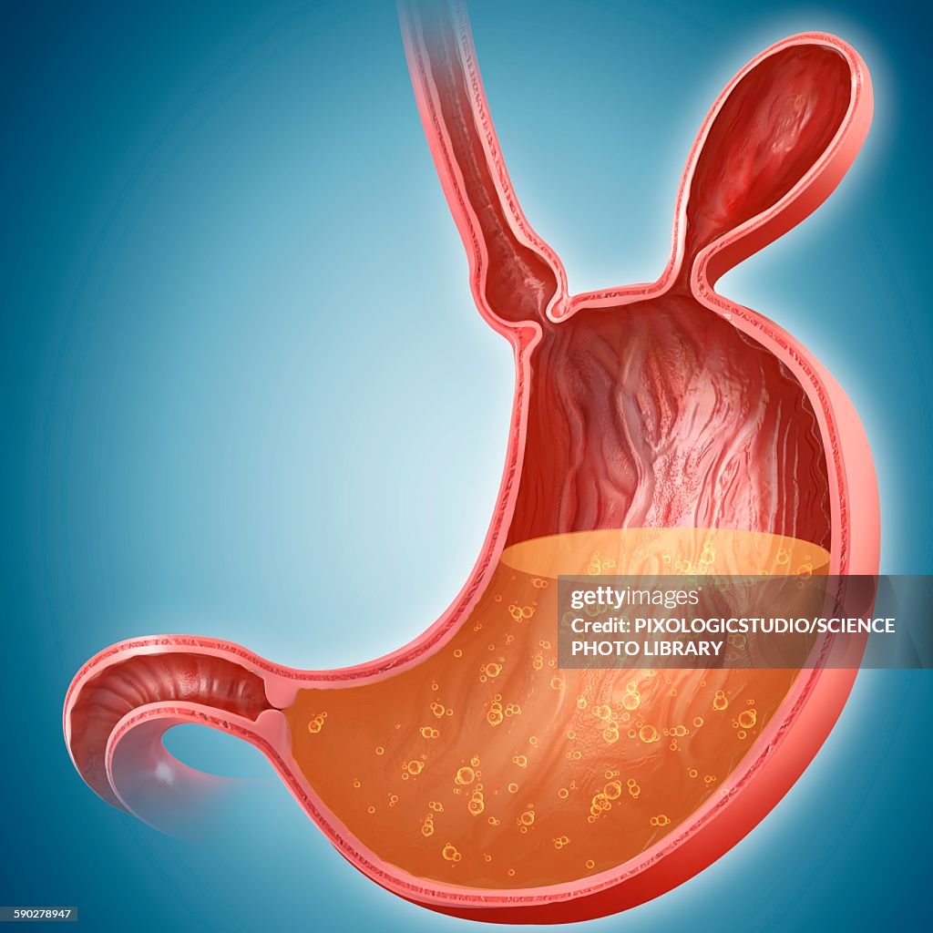 Stomach with hernia, illustration