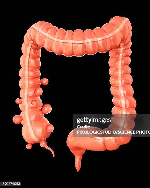 diverticulitis, illustration - diverticulitis stock illustrations