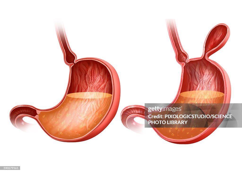 Stomach with and without hernia