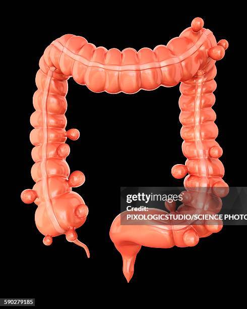 diverticulitis, illustration - diverticulitis stock-grafiken, -clipart, -cartoons und -symbole