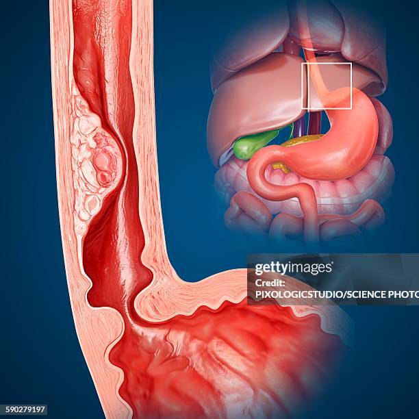 oesophageal cancer, illustration - oesophagus stock illustrations