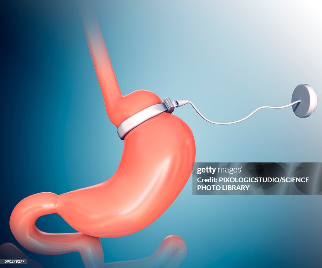 Human gastric band, illustration
