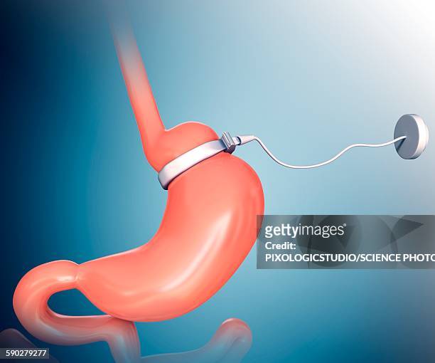human gastric band, illustration - gastric band treatment stock illustrations