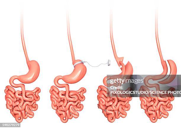 ilustrações de stock, clip art, desenhos animados e ícones de weight loss surgery, illustration - gastric band treatment