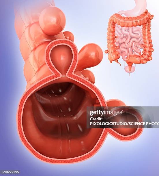 diverticulitis, illustration - diverticulosis stock illustrations