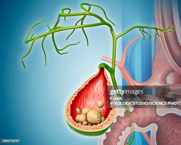 gall stones, illustration - gall bladder stock illustrations