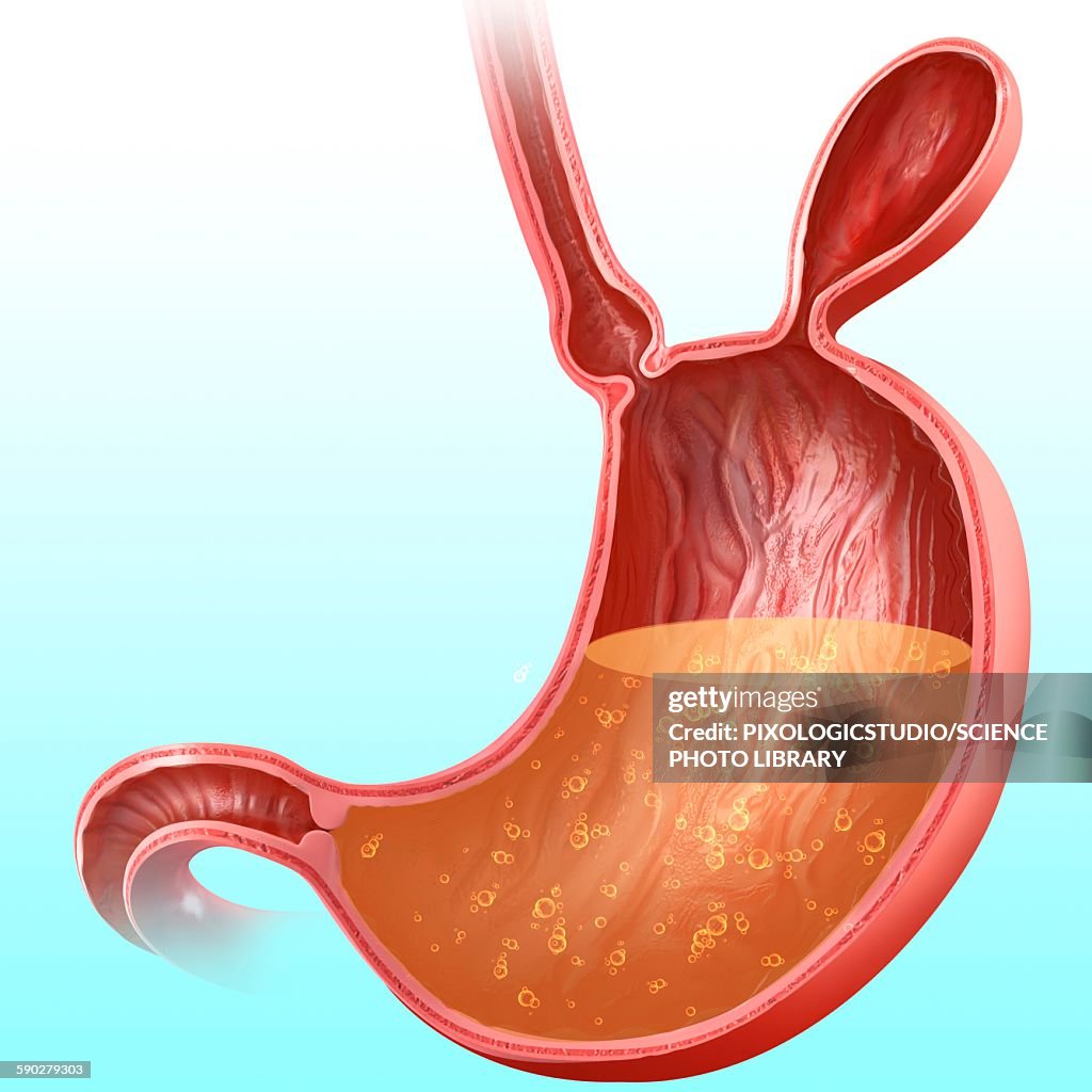 Stomach with hernia, illustration