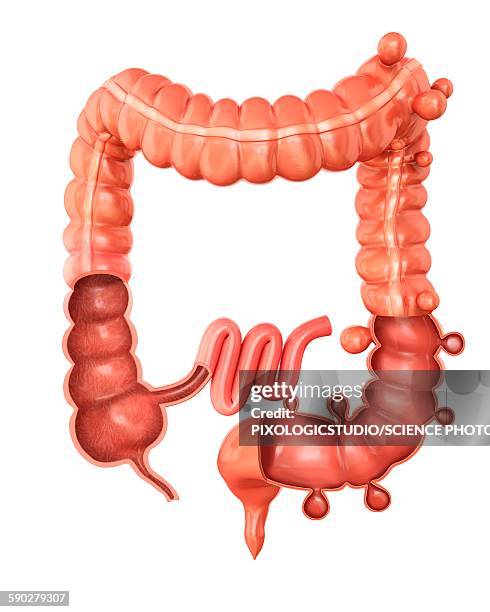 diverticulitis, illustration - diverticulitis stock illustrations