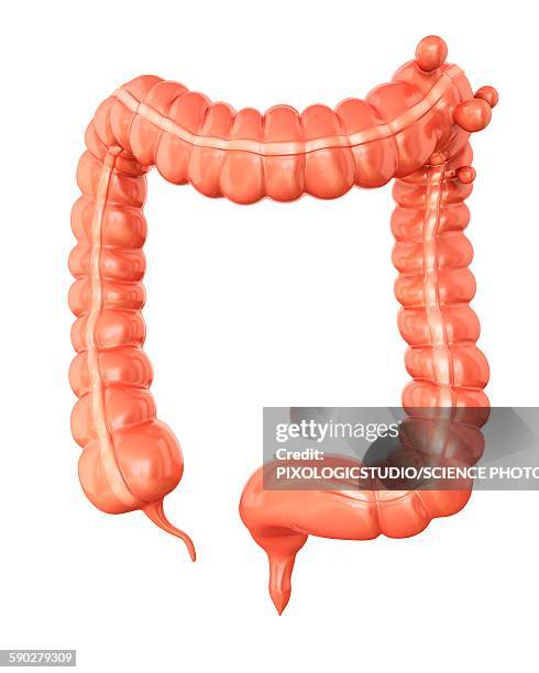 diverticulitis, illustration - diverticulitis stock illustrations