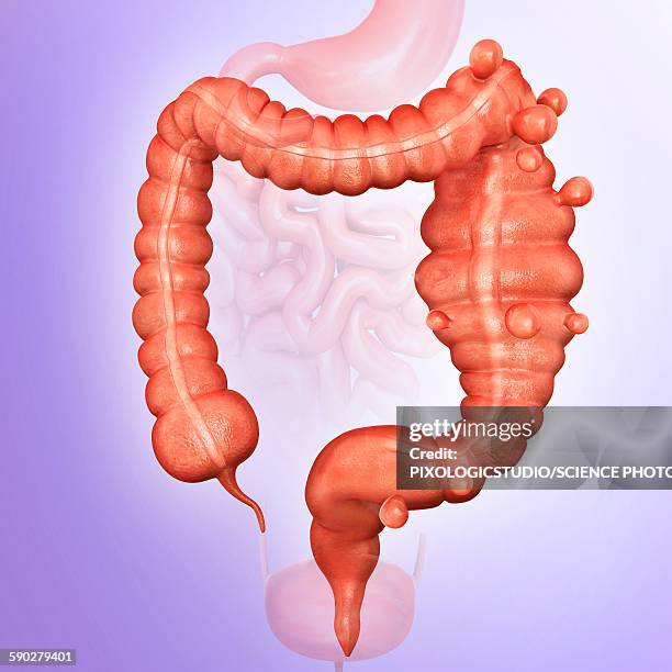 megacolon and diverticulitis - diverticulitis stock illustrations