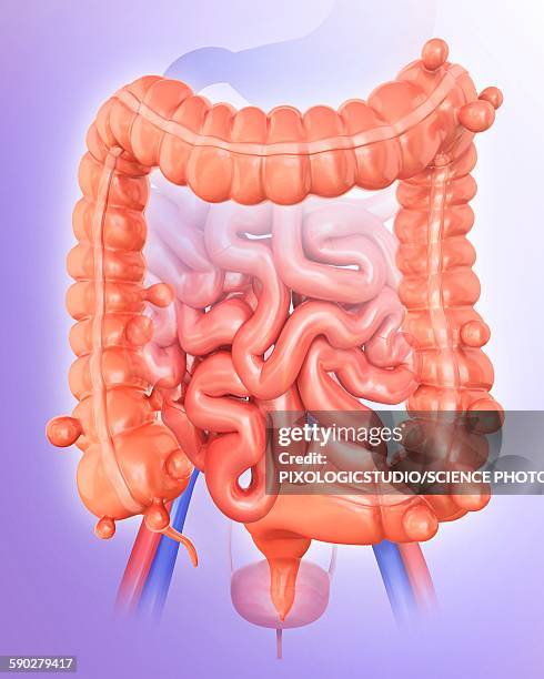 diverticulitis, illustration - diverticulitis stock illustrations