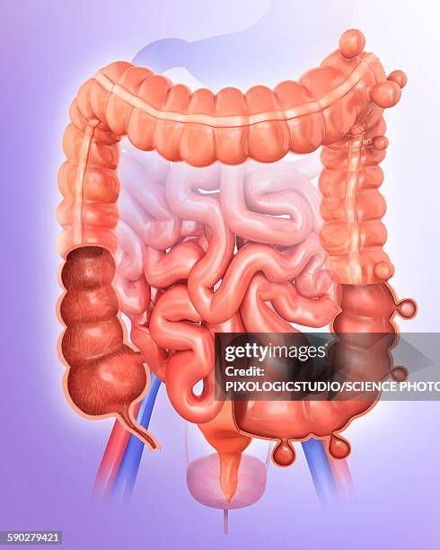 diverticulitis, illustration - diverticulitis stock illustrations