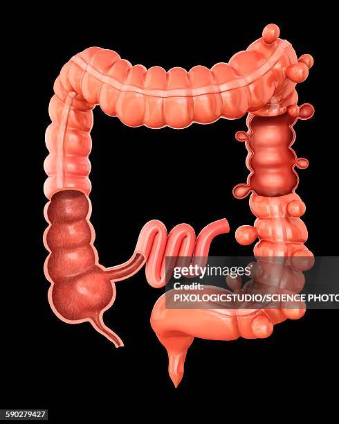 diverticulitis, illustration - diverticulitis stock illustrations