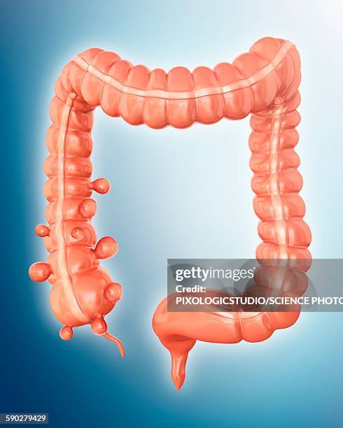 diverticulitis, illustration - diverticulitis stock illustrations