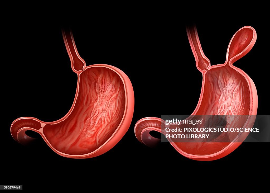 Stomach with and without hernia