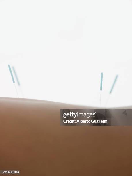 close up of acupuncture needles in back of woman - acupuncture needle stock pictures, royalty-free photos & images