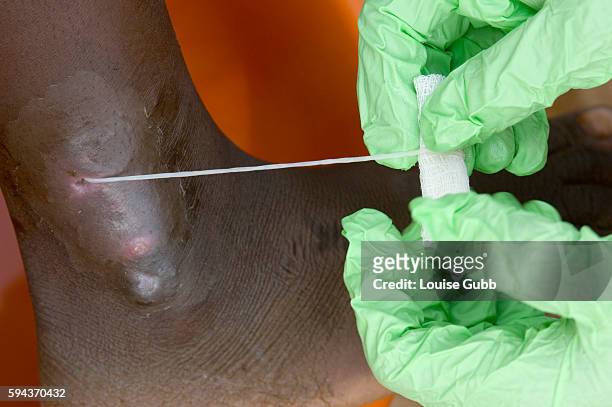 Patient with a guinea worms emerging, at the Savelugu Case Containment Center. The worm is wrapped around a moist bandage, to prevent it breaking and...