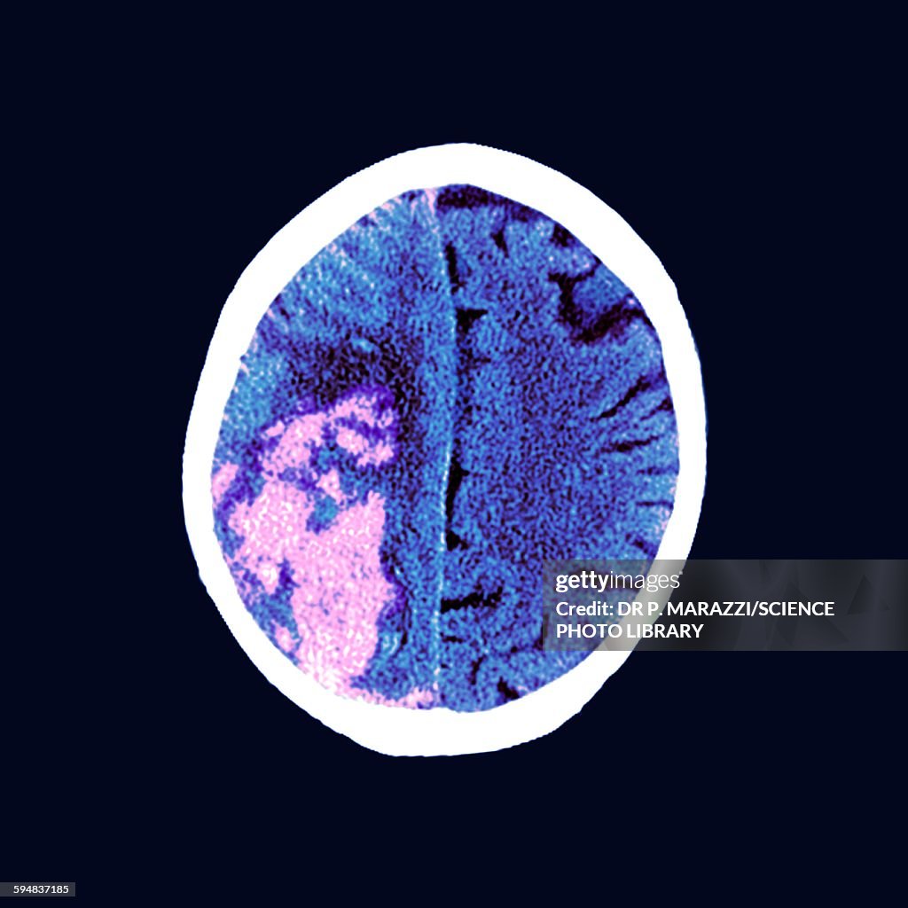 Brain in stroke, MRI scan