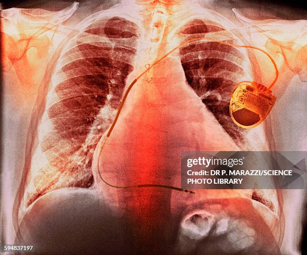 pacemaker in heart disease, x-ray - atrial fibrillation stock pictures, royalty-free photos & images