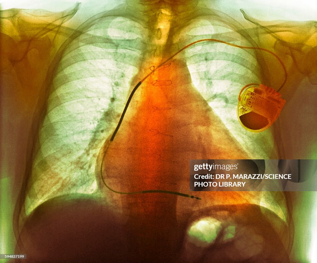 Pacemaker in heart disease, X-ray