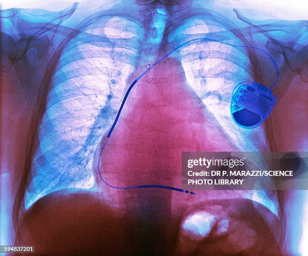 pacemaker in heart disease, x-ray - atrial fibrillation stock pictures, royalty-free photos & images