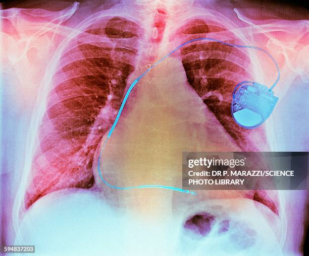 pacemaker in heart disease, x-ray - atrial fibrillation stockfoto's en -beelden