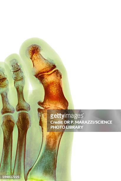 degenerative foot deformation, x-ray - bent stockfoto's en -beelden
