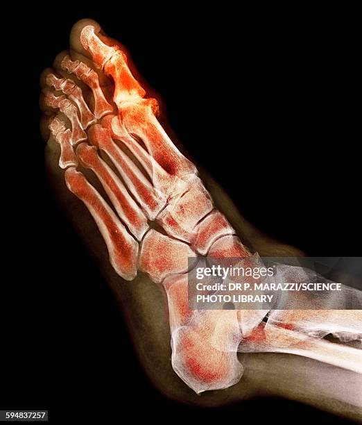 degenerative foot deformation, x-ray - deformation stock pictures, royalty-free photos & images