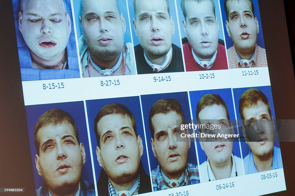 Extensive Face Transplant Patient Discusses Recovery In New York