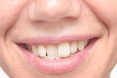 woman crooked teeth