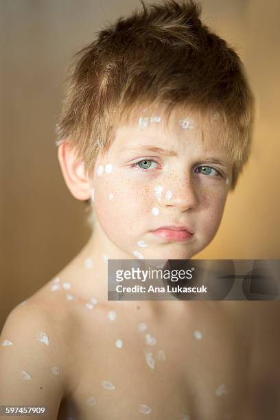 portrait of aboy with chickenpox - chickenpox stock pictures, royalty-free photos & images