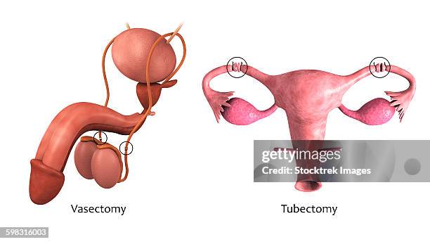 ilustrações de stock, clip art, desenhos animados e ícones de biomedical illustration of a vasectomy and tubectomy. - vasectomia
