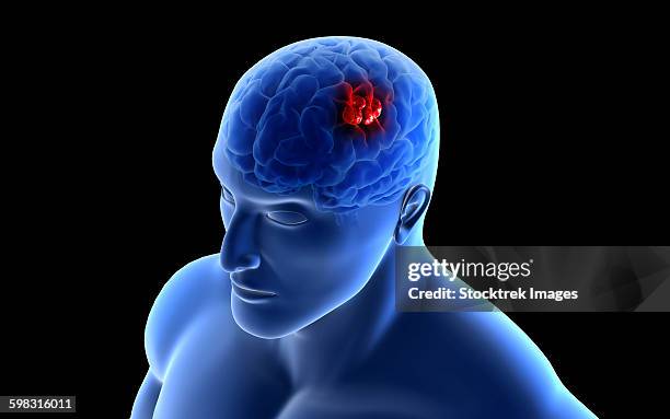 conceptual image of a tumor in human brain. - neuroanatomy stock illustrations