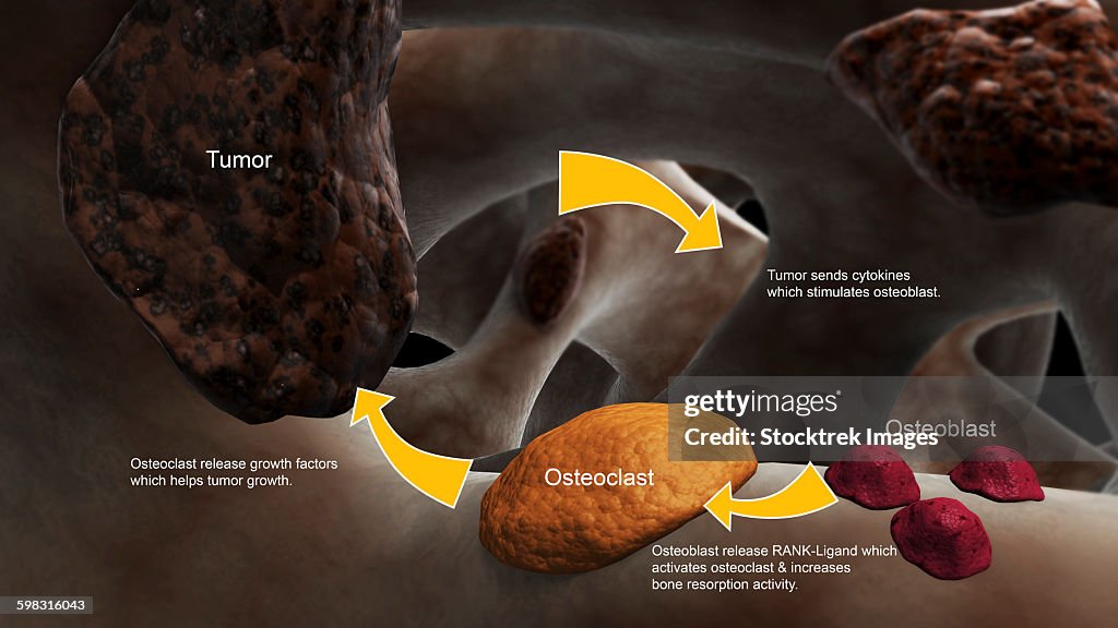 Conceptual image illustrating the process of bone metastasis.