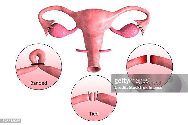 biomedical illustration of a tubectomy. - 性腺点のイラスト素材／クリップアート素材／マンガ素材／アイコン素材