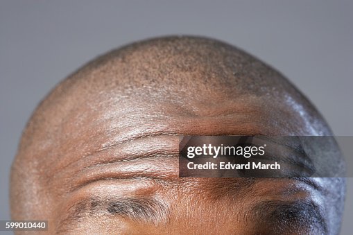 Forehead Only Mans Forehead High-Res Stock Photo - Getty Images